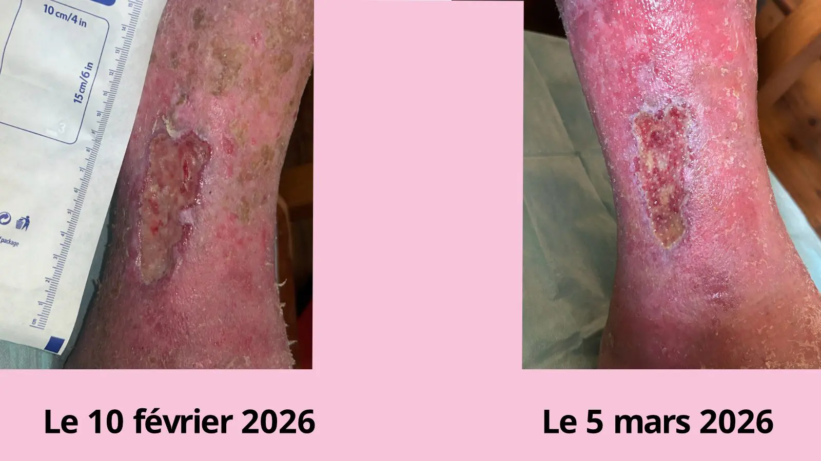 Evolution plaie chronique traitement pression négative